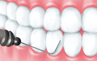 歯間清掃のイメージ