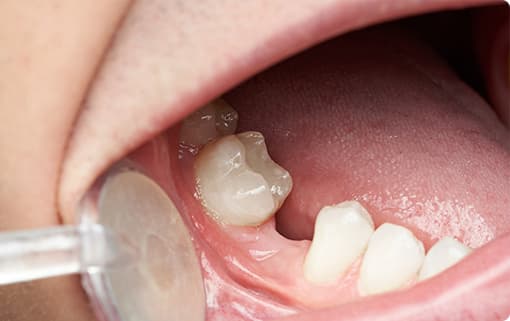 失った歯をそのままにしているの危険性イメージ
