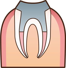 歯内治療後、支台歯の形を整えます