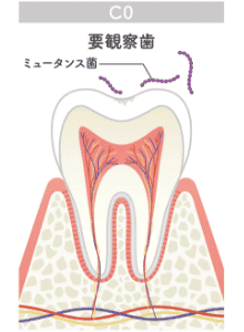 要観察歯のイラスト