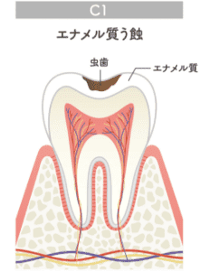 エナメル質う蝕のイラスト