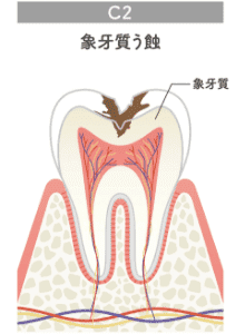 象牙質う蝕のイラスト