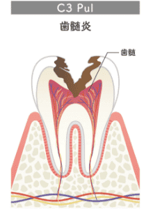歯髄炎のイラスト