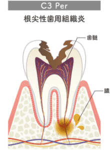 根尖性歯周組織炎のイラスト