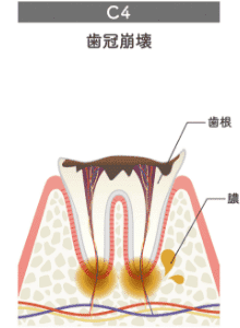 歯冠崩壊のイラスト