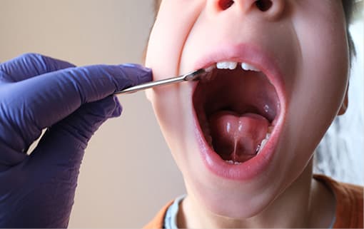 口腔内の機能阻害や不正歯列を防止しますのイメージ