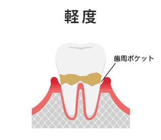 軽度のイメージ