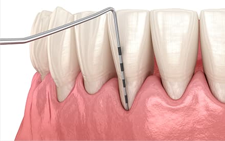 歯周病の検査のイメージ画像