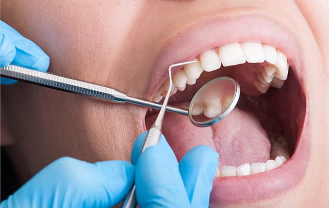 むし歯・歯周病の検査のイメージ