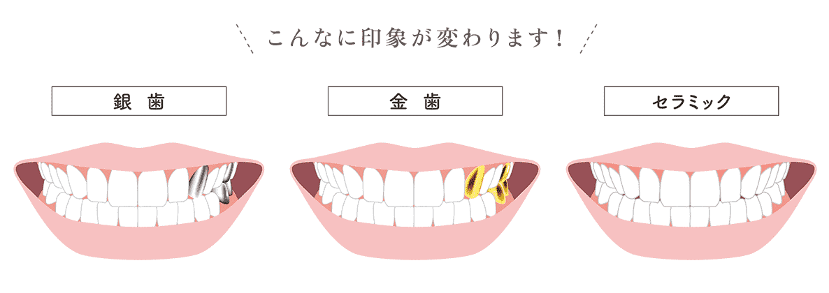 こんなに印象が変わります　銀歯　金歯　セラミック